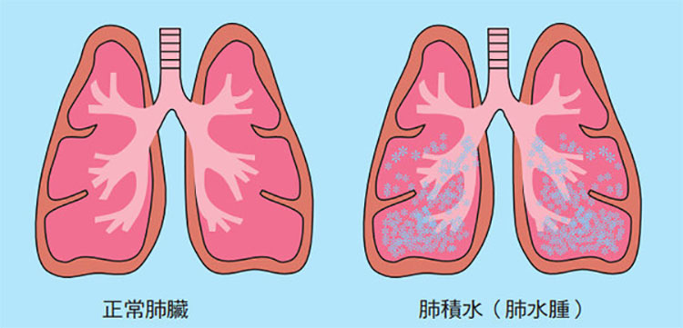 威而鋼在高山症預防中的應用