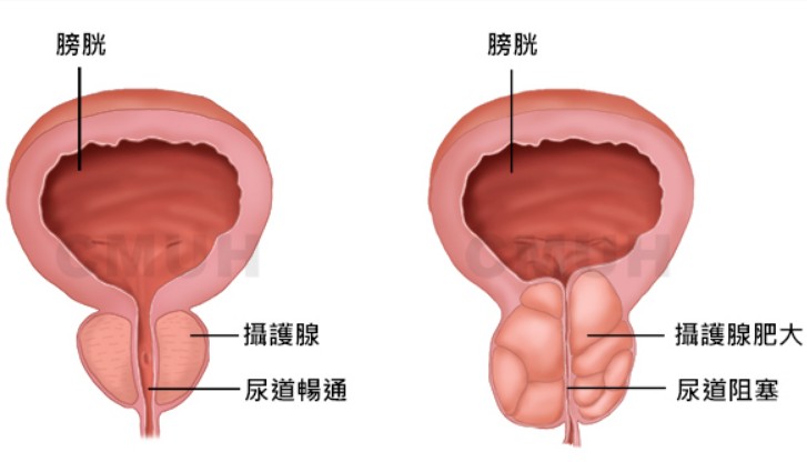 威而鋼其他醫療用途