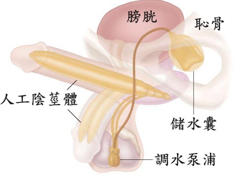 人工陰莖植入術